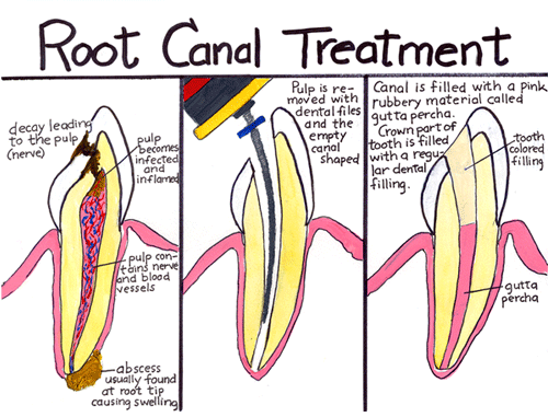 rootcanal.gif